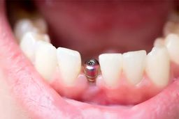 مراحل ایمپلنت دندان چگونه است؟ + قیمت در سال 1404