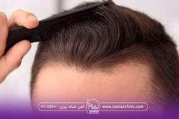 درصد موفقیت کاشت مو چقدر است؟